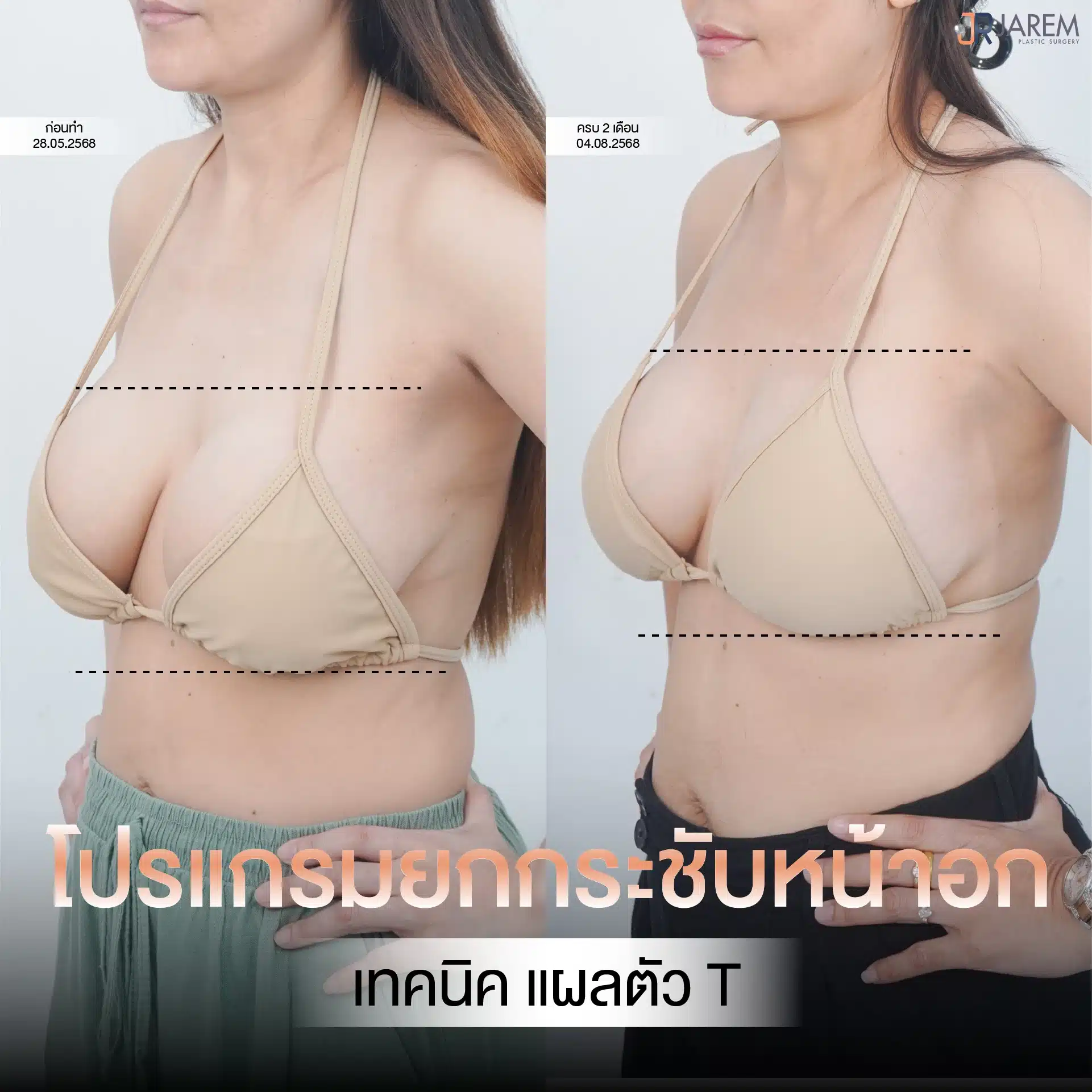 Jarem Clinic โปรโมชัน ยกกระชับหน้าอก เทคนิคแผล ตัว T