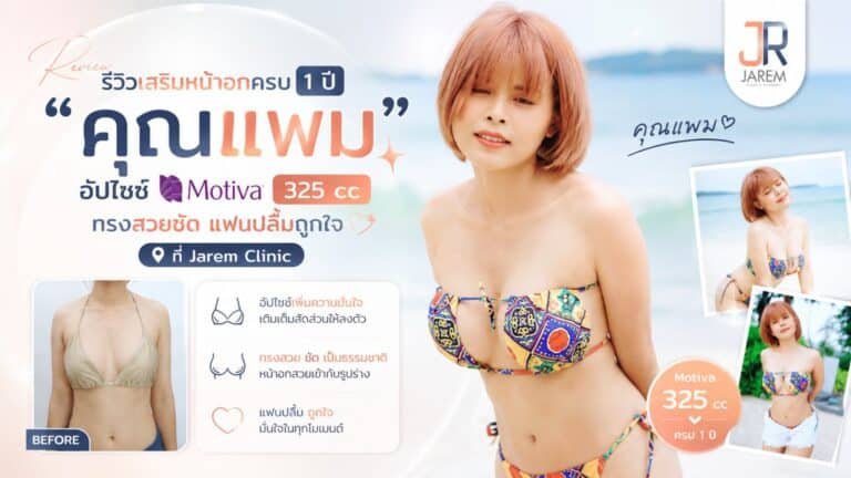 รีวิวเสริมหน้าอกครบ 1 ปี Motiva 325 cc คุณแพม จาเรมคลินิก