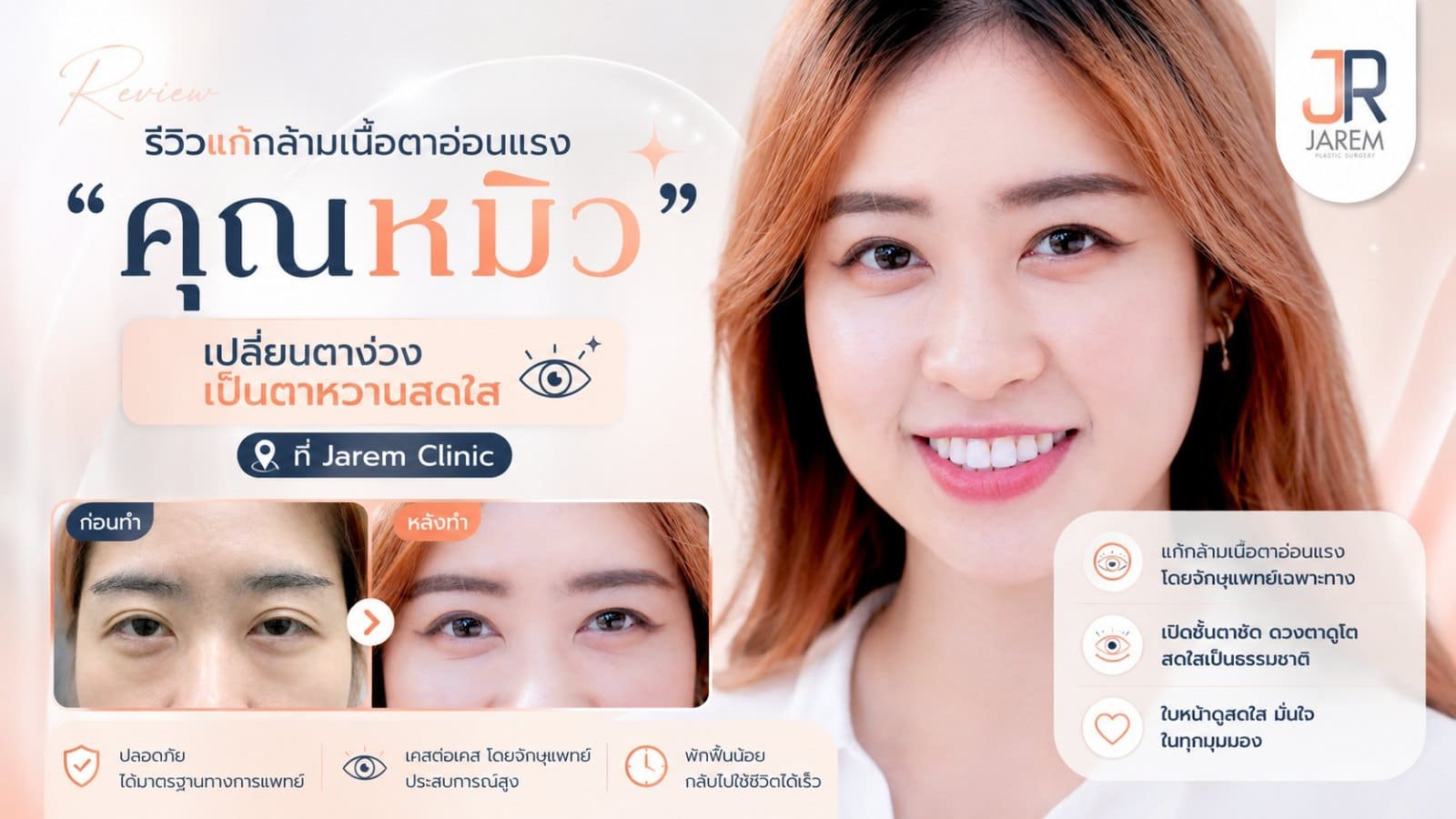 รีวิวแก้กล้ามเนื้อตาอ่อนแรง คุณหมิว จากตาง่วงเป็นตาสดใส