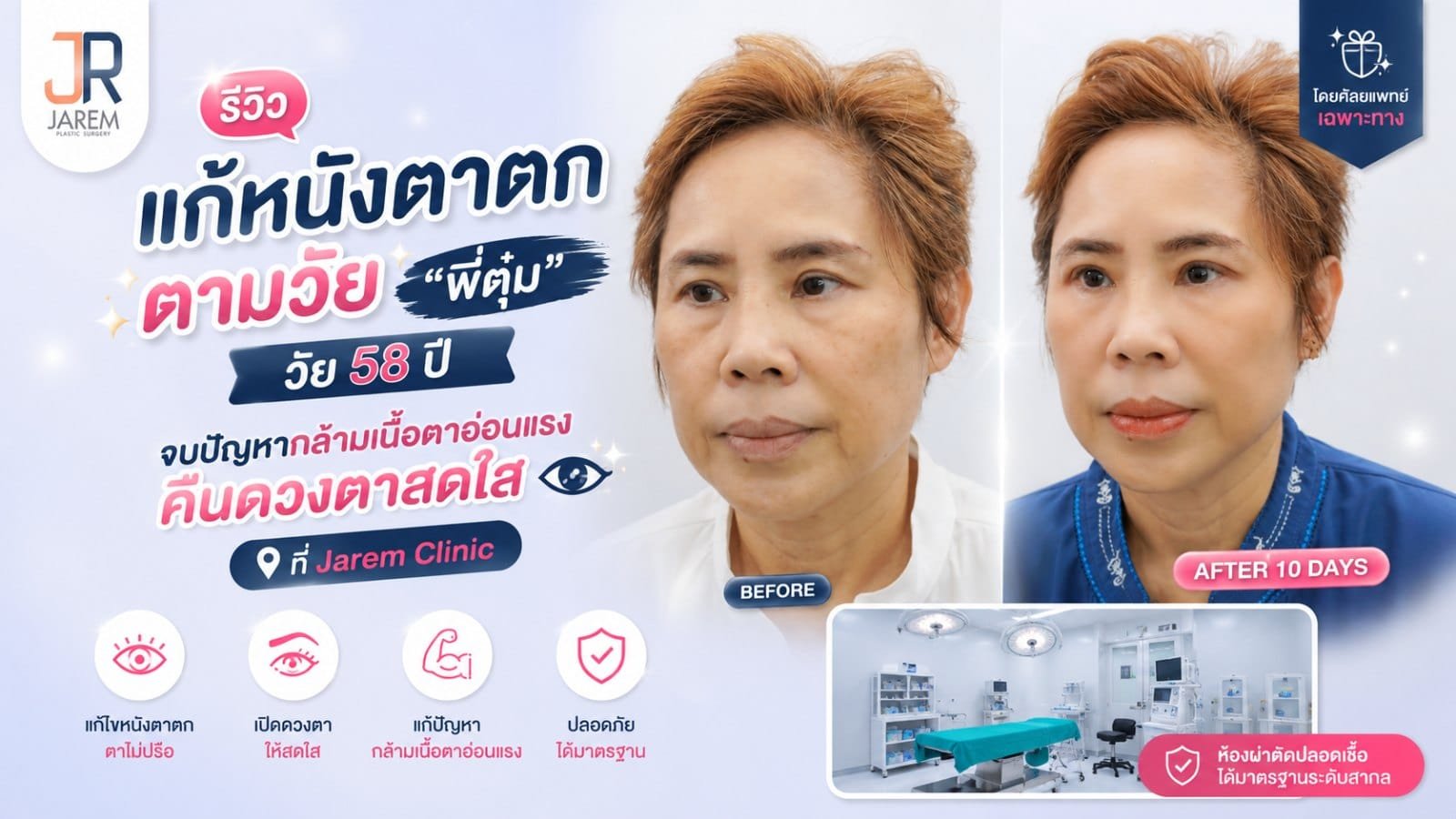 รีวิวแก้หนังตาตกตามวัย “พี่ตุ๋ม” 58 ปี เจอกล้ามเนื้อตาอ่อนแรงซ่อนอยู่